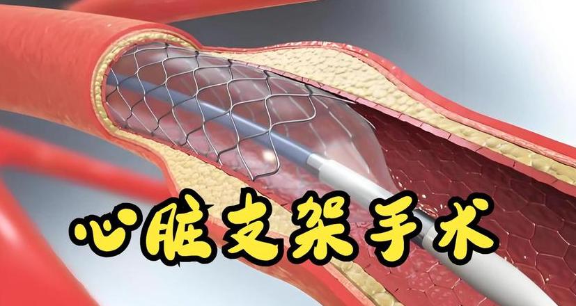 心脏装了支架能活多久