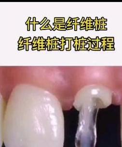 牙齿全瓷桩 纤维桩对比