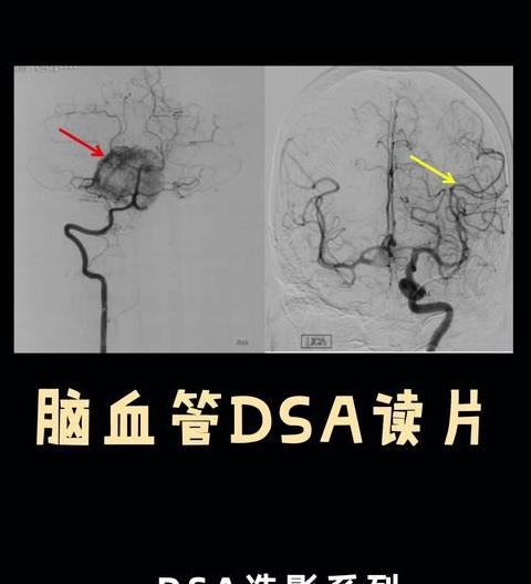 造影dsa影响大吗