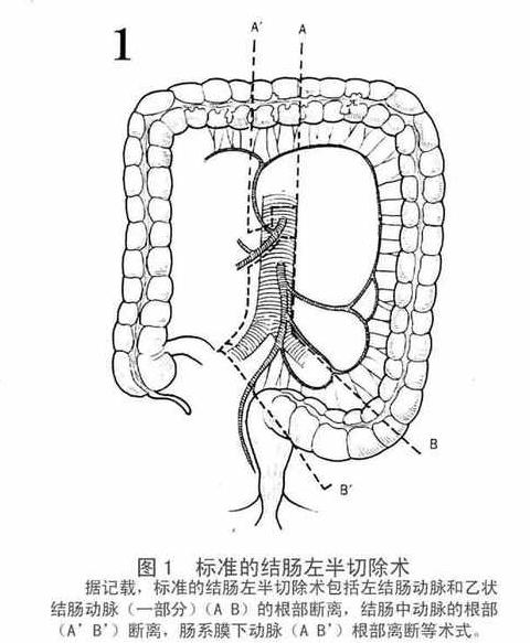 结肠次全切除术范围有哪些