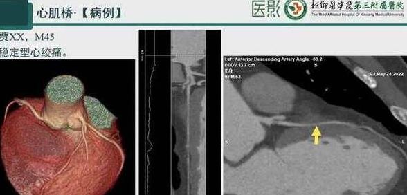 心脏cta全称