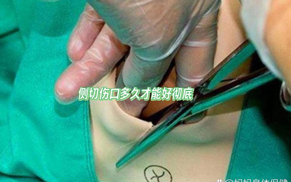 侧切多久能完全恢复